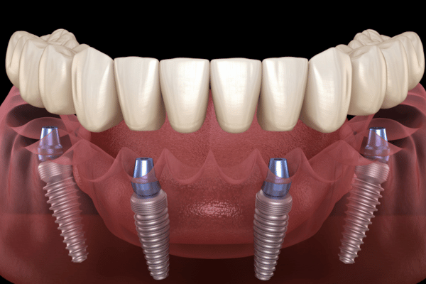 Dentures and fixed prosthesis