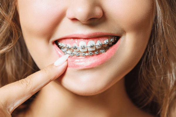 dental braces